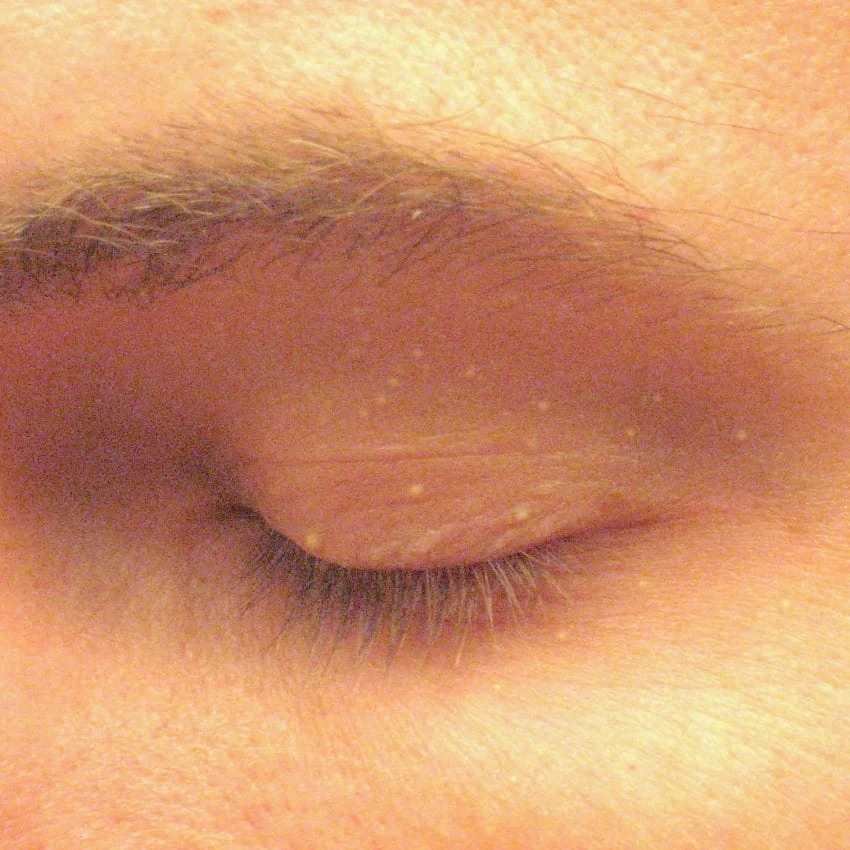 Κοιτάξτε γύρω απο τα μάτια σας! Εαν έχετε αυτά τα σπυράκια δείτε τι σημαίνει και τι πρέπει να προσέξετε